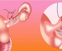 Tubal Ligation Reversal