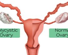 How PCOS Affects Fertility
