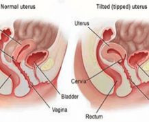 How to Get Pregnant with a Tilted Uterus