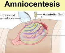 What is amniocentesis