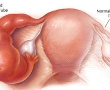 Tubal factor infertility